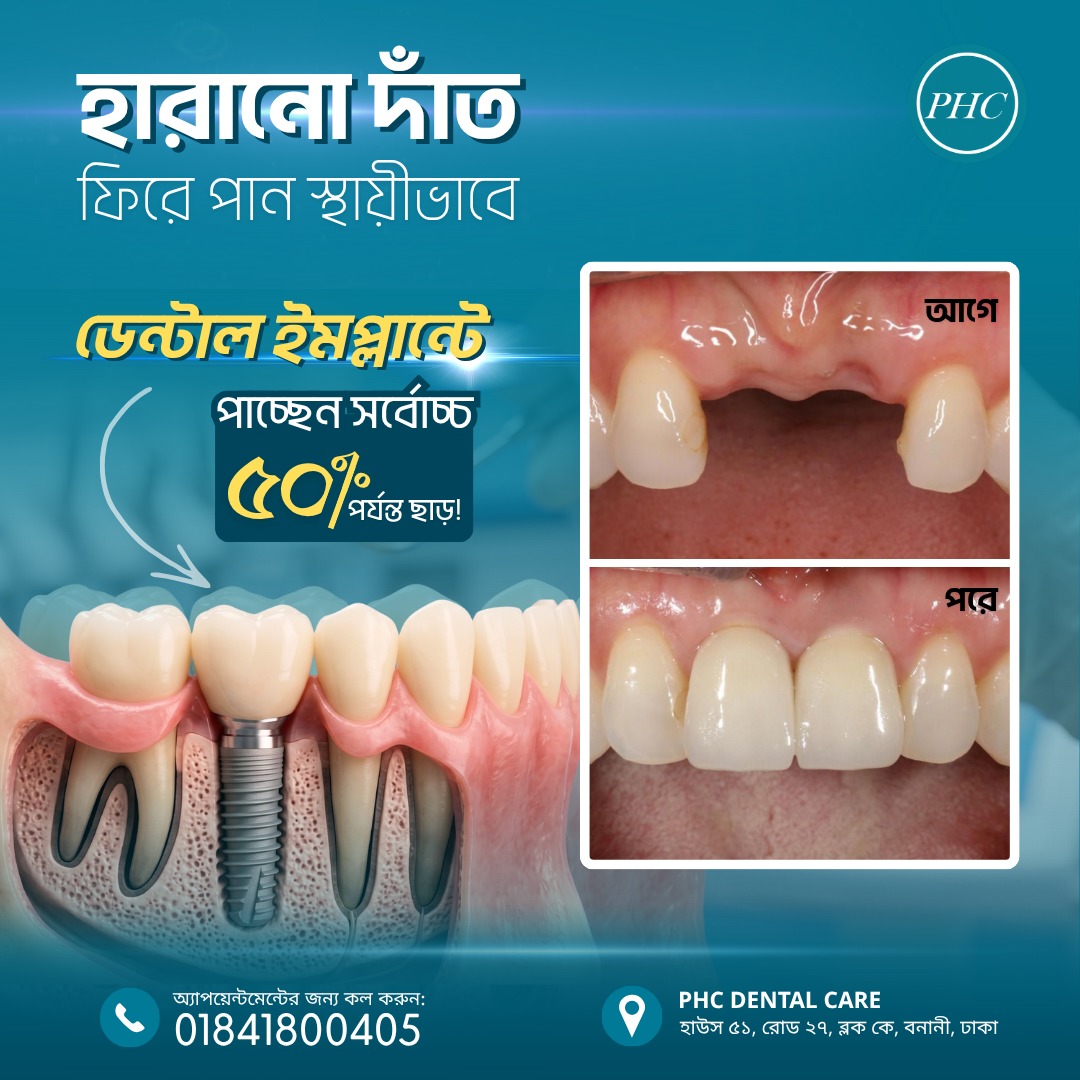 PHC Dental Care post on permanent dental implants, before and after.